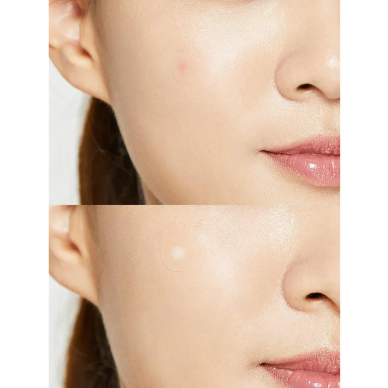 ACNE PIMPLE MASTER PATCH 1 PACK (24PCS)	